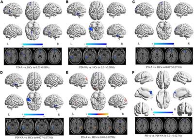 Abnormal brain activities in multiple frequency bands in Parkinson’s disease with apathy